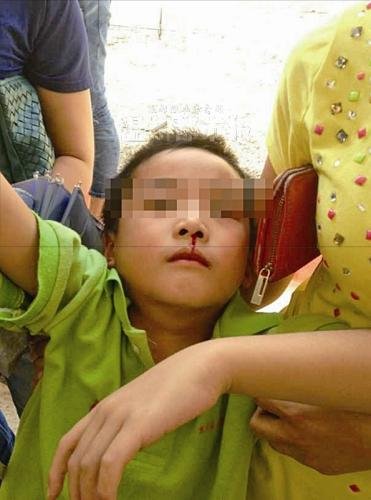 昨天上午,樂清市北白象鎮第九小學,一名學生突然流鼻血被送往醫院。 家長供圖